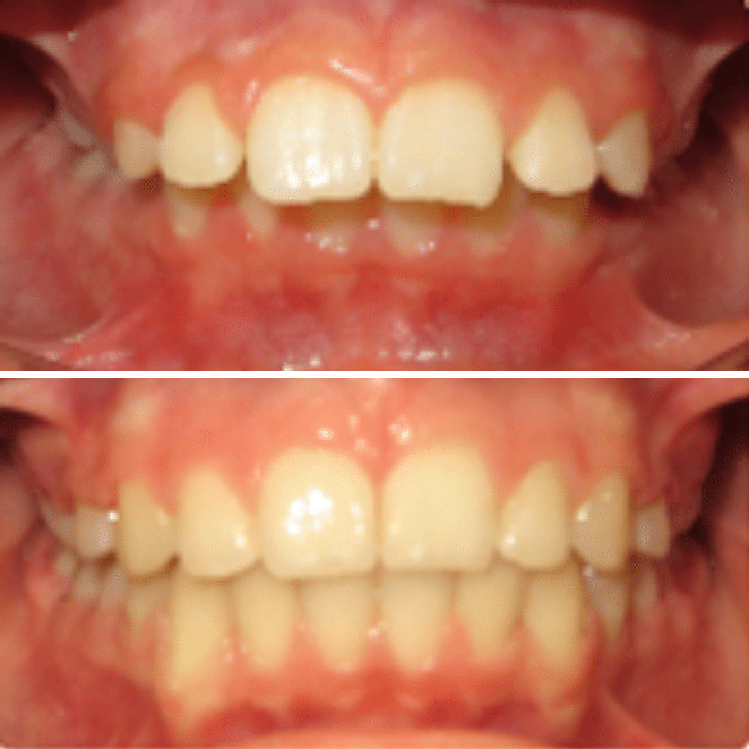 Smiles By Design - Before & After Orthodontic Treatment