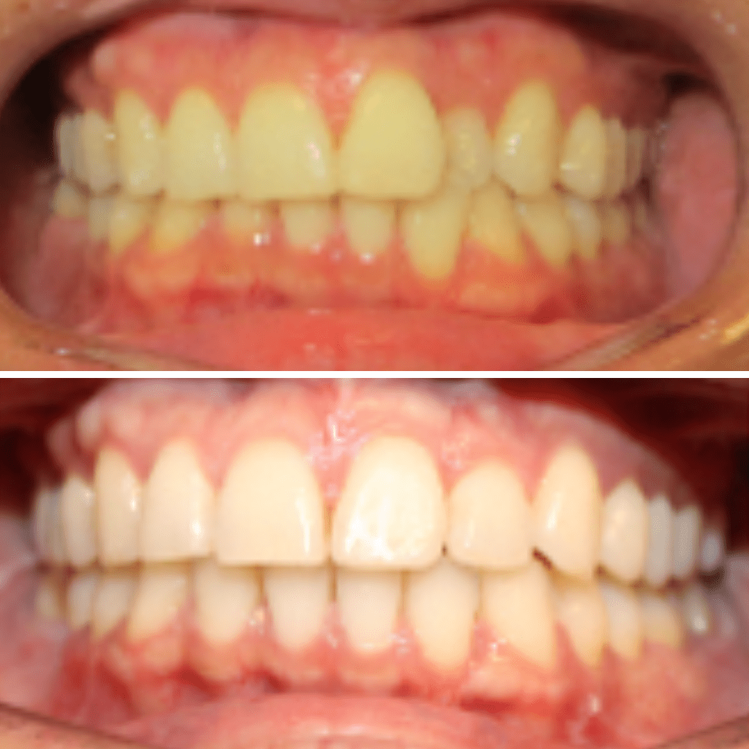 Smiles By Design - Before & After Orthodontic Treatment