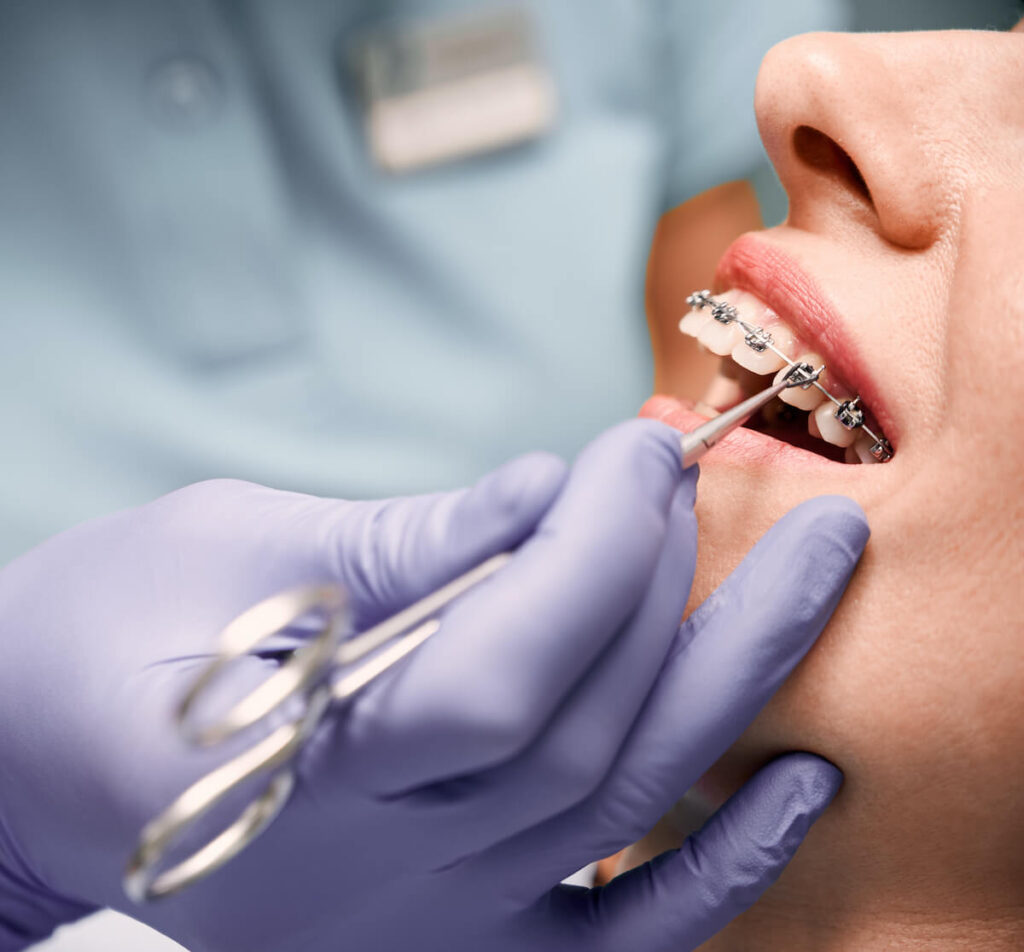 Types of braces in Diberville, MS