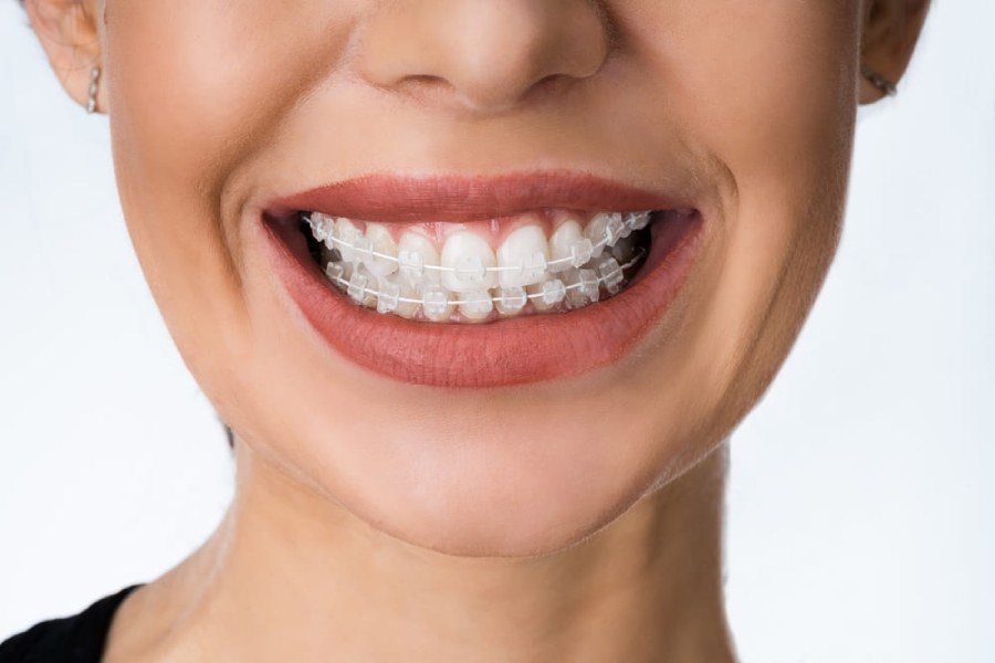 clear-braces