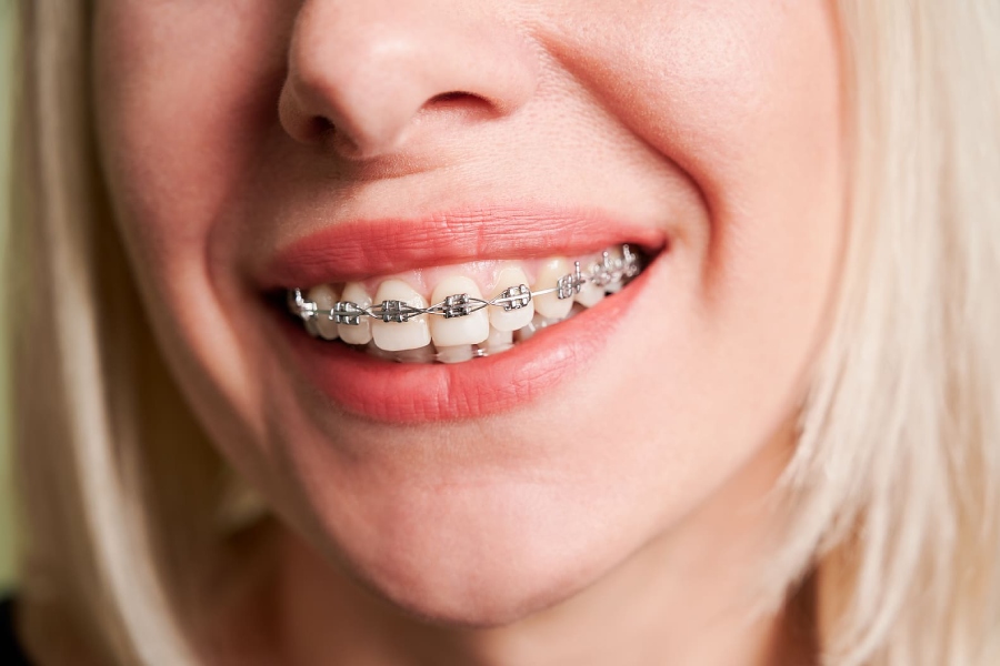 traditional-braces