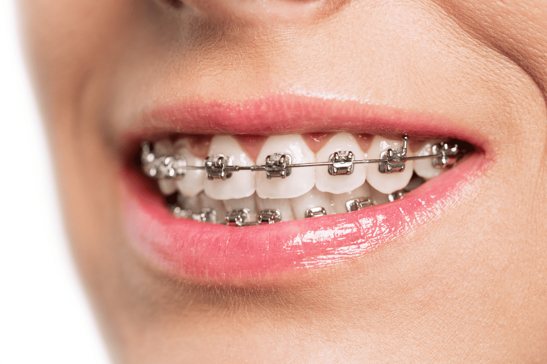 Smiles By Design orthodontic consultation