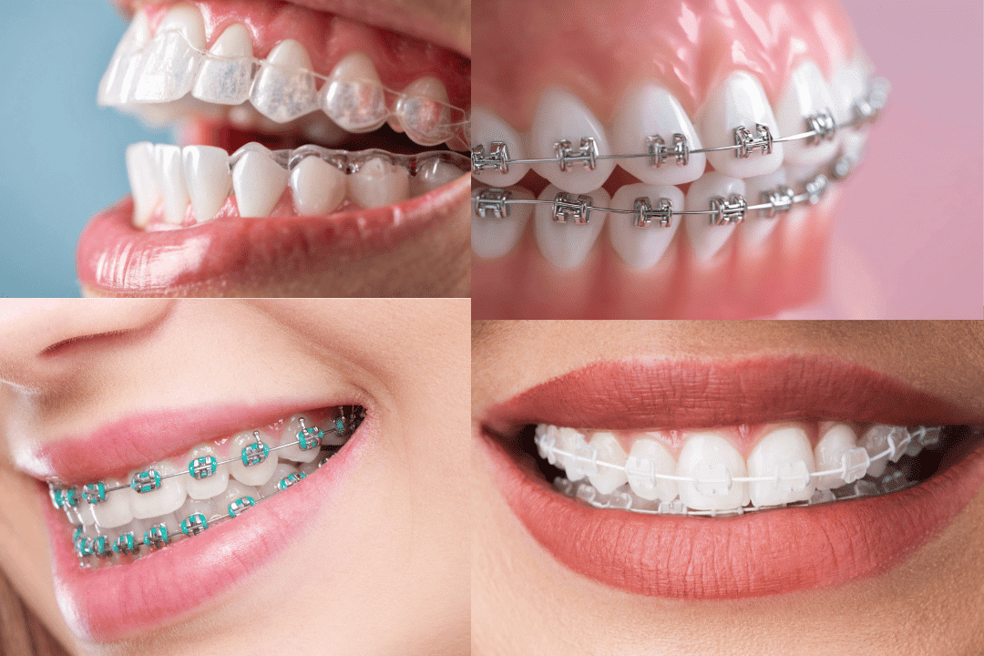 Smiles By Design orthodontic treatments comparison