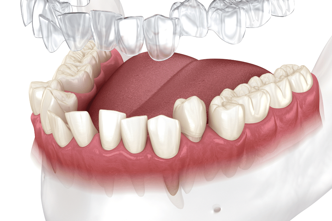 invisalign fitting