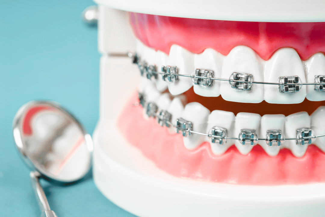 metal braces for teeth alignment