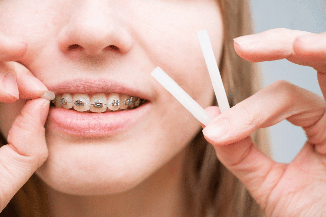 orthodontic wax applied to braces at night