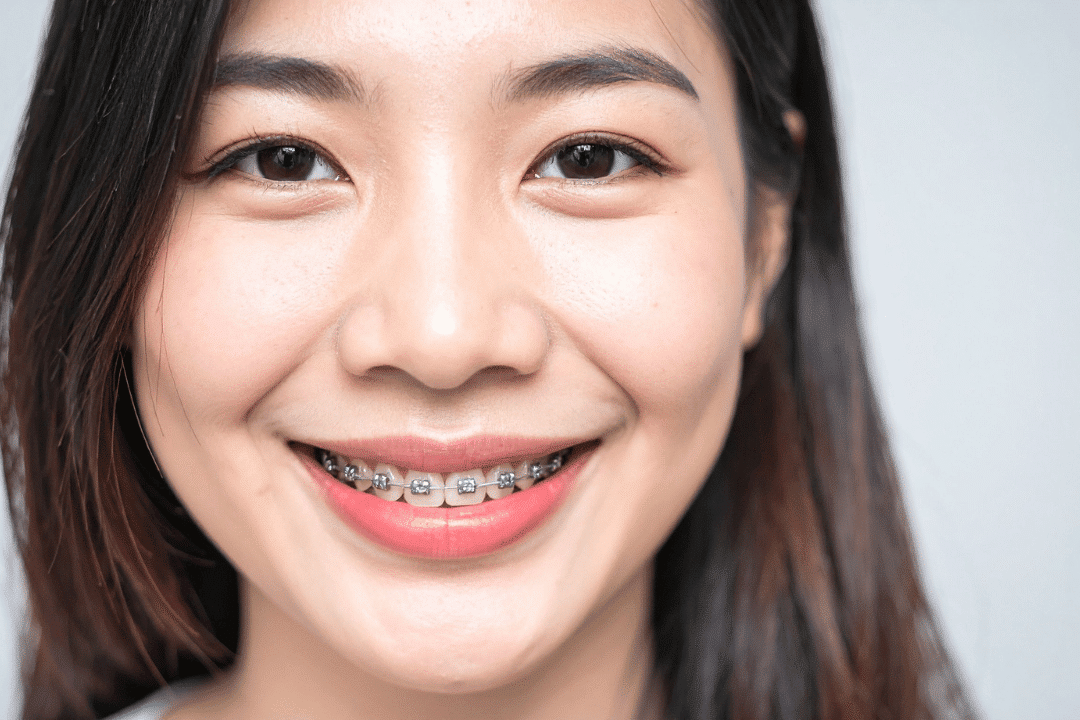 adult orthodontics options that improve bite function and oral health care