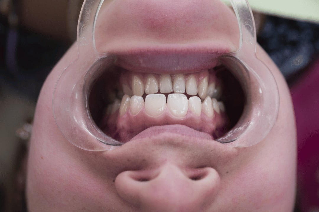 Dentofacial Orthopedic Treatment For Bite Correction