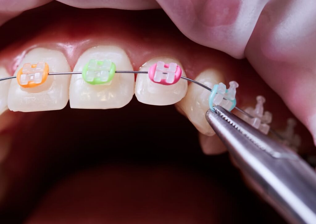 How to Wear Braces Elastics Correctly