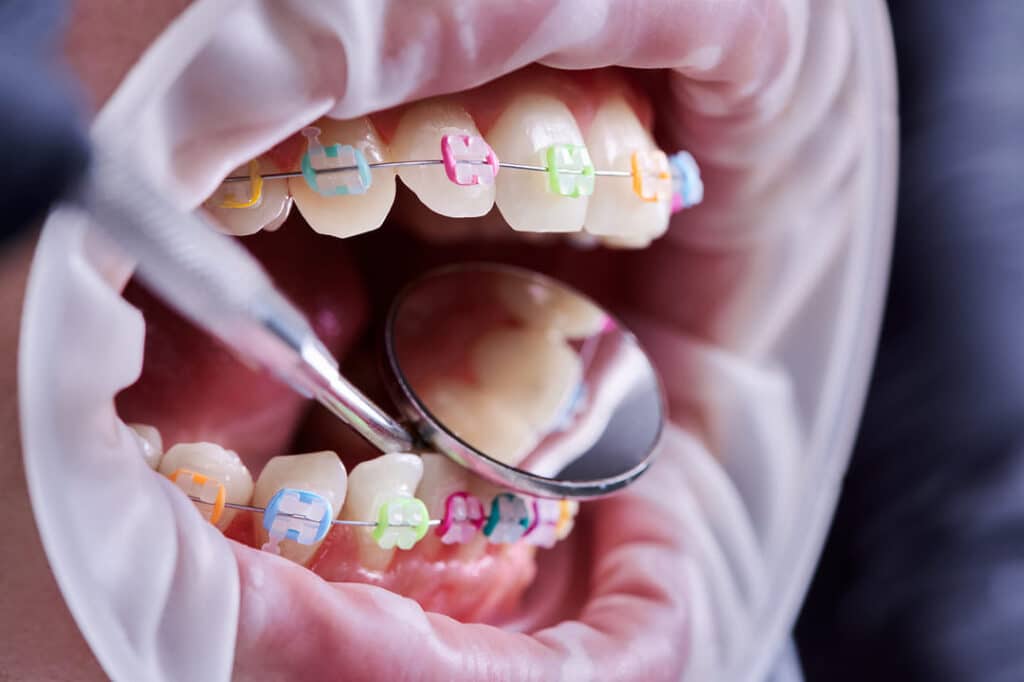 Purpose of Orthodontic Rubber Bands