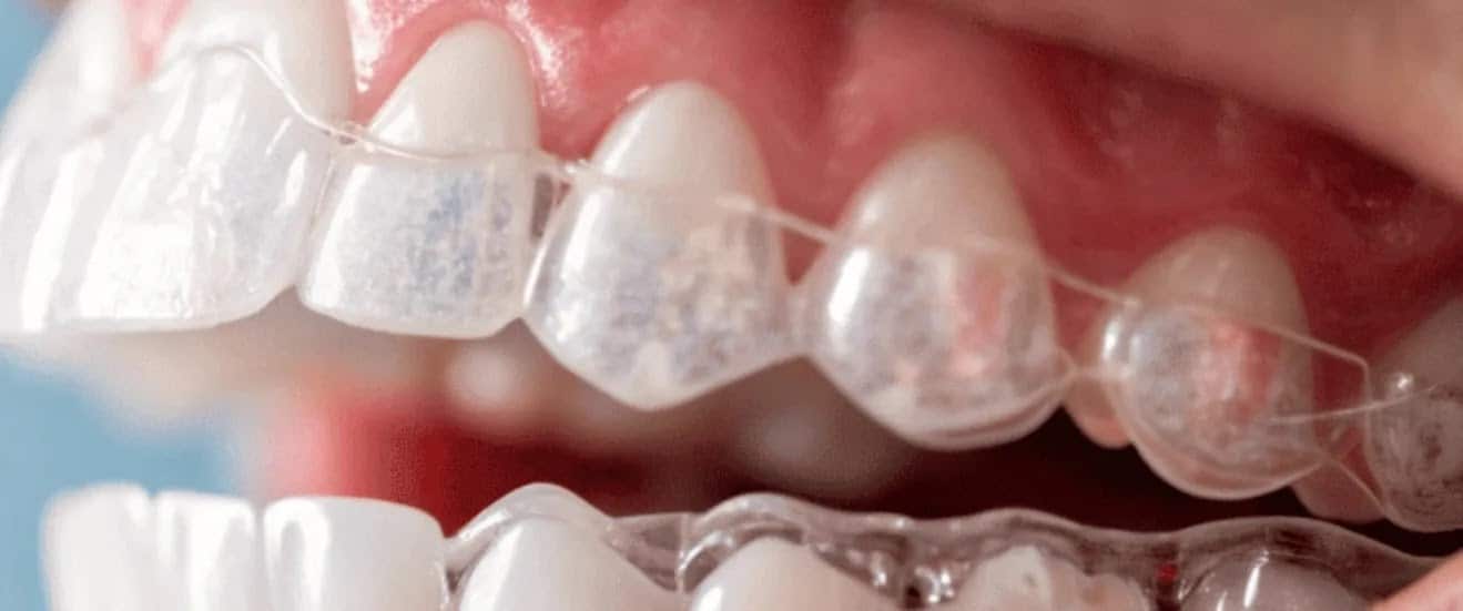 clear ceramic braces on teeth showing less visible alternative to traditional metal braces