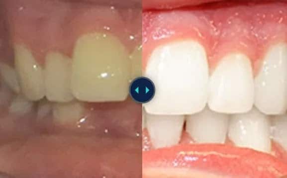 Dental braces before and after results showing how orthodontic treatment straightens misaligned teeth