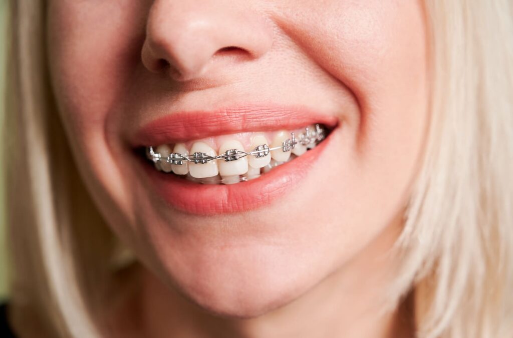 Close-up of a smiling woman showing her orthodontic braces