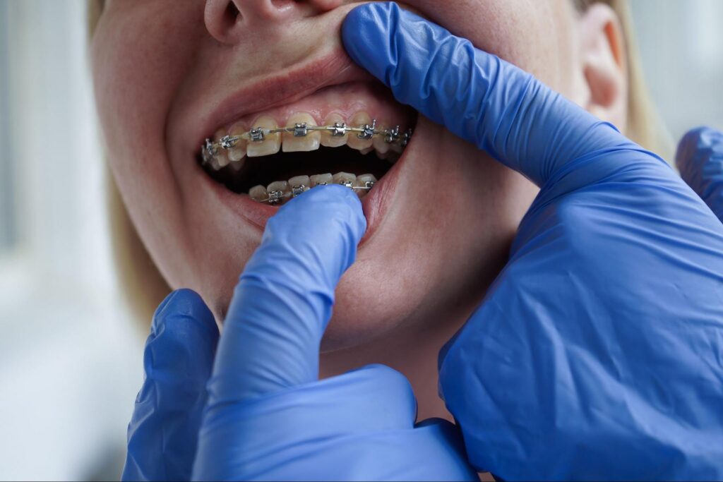 Dentist in blue gloves examining metal braces on a patient