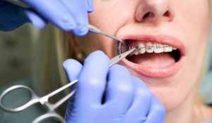 Orthodontist using dental tools to adjust a patient's braces