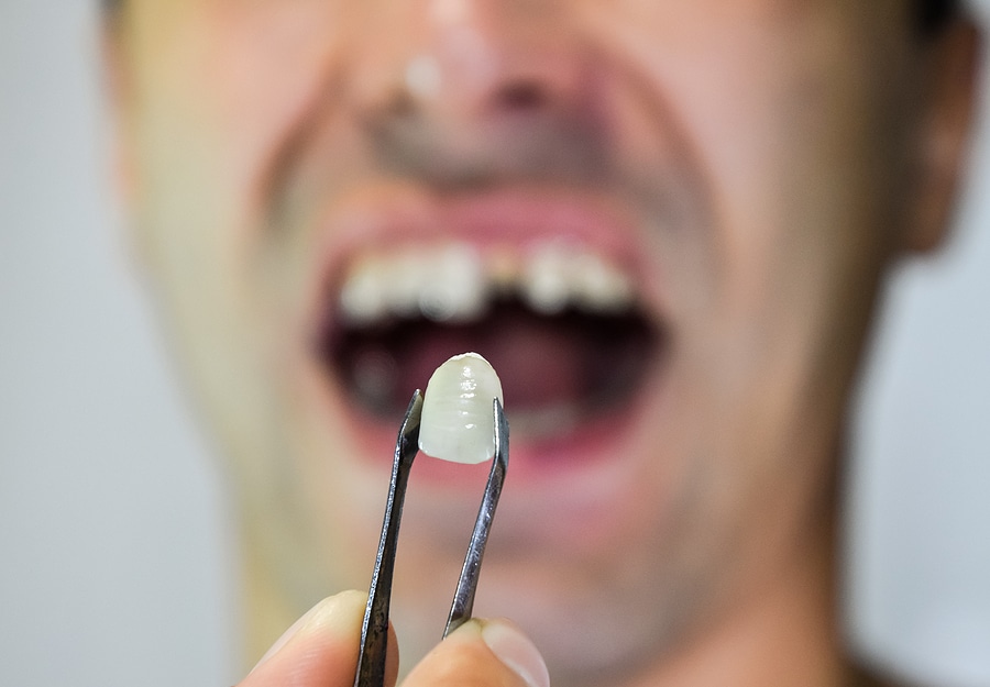 Dentist positioning a metal ceramic dental prosthesis